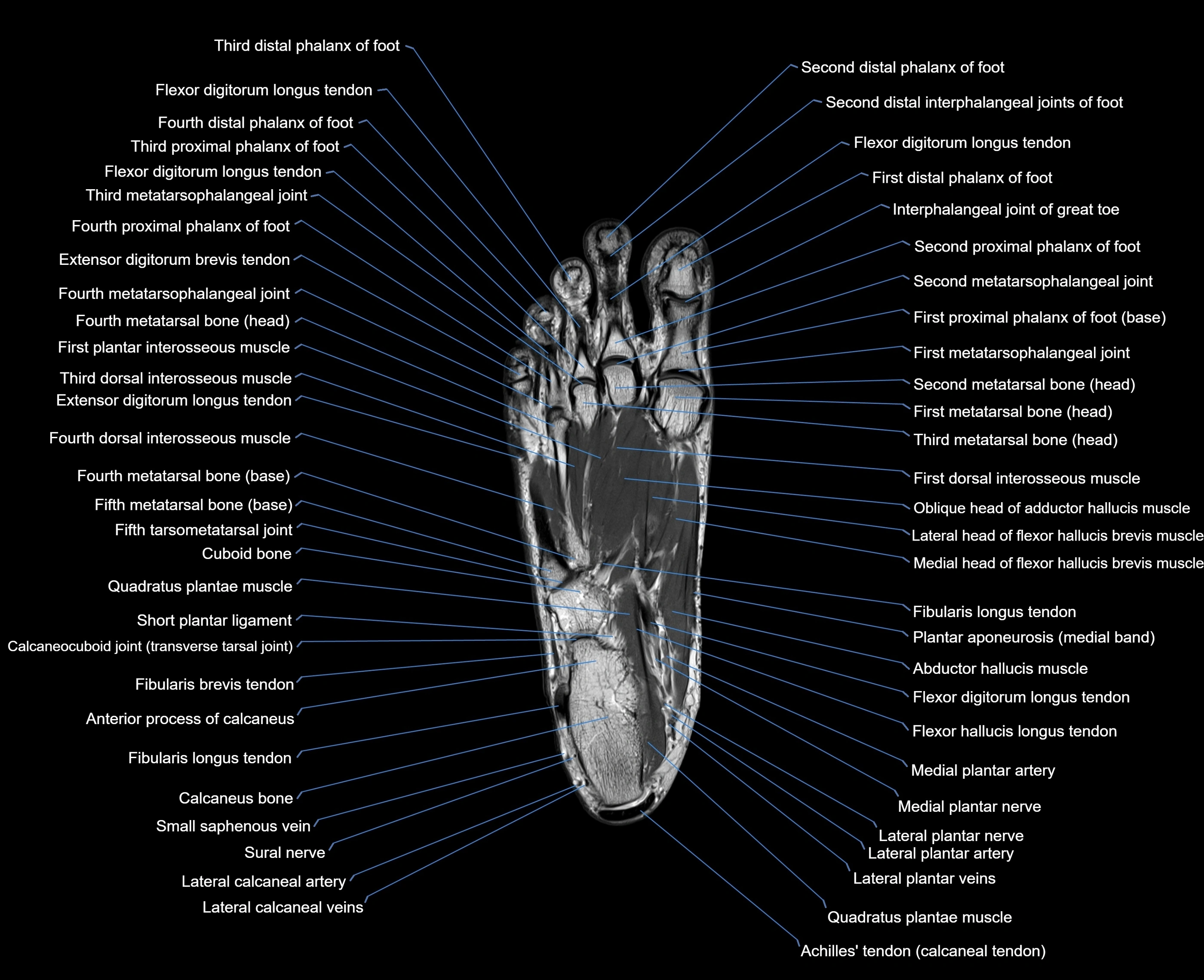 MRI foot coronal cross sectional anatomy 3T  radiology  image-img-00001-00022.webp
